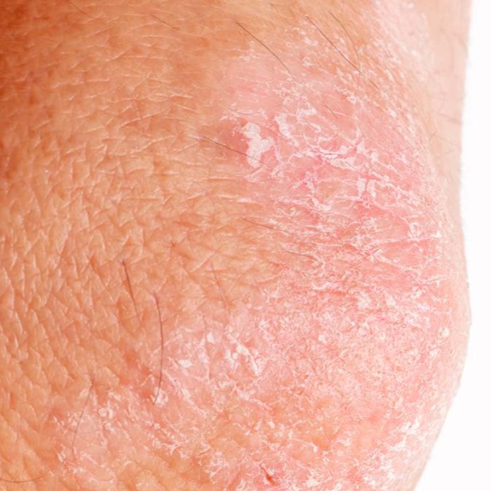 Jabón Natural De Manteca De Coco (90g) - Para Piel Seca Y Agrietada - Calma La Piel Con Psoriasis, Dermatitis O Eccemas_5