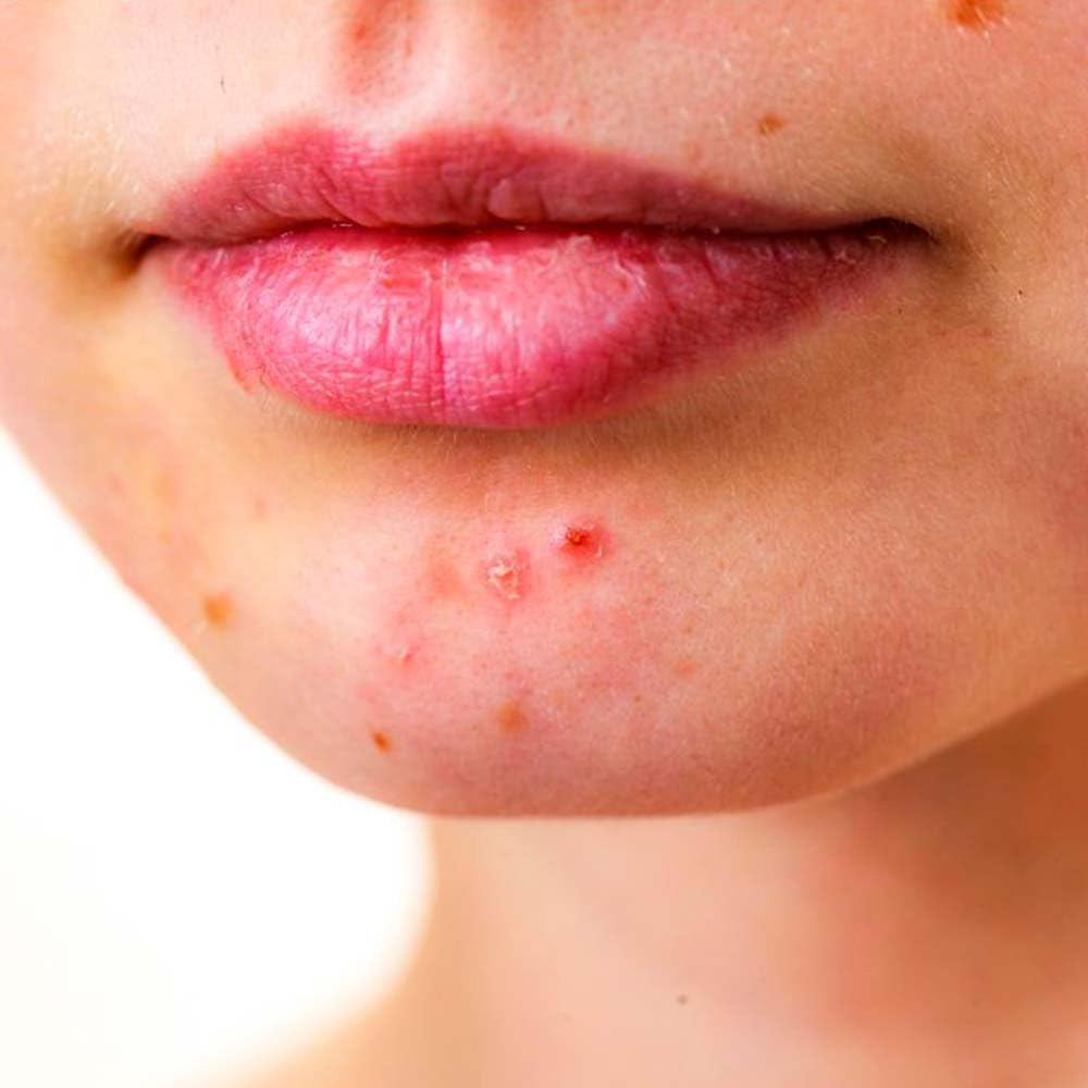 Pack 5 Jabón Natural Exfoliante Limón - Regula El Nivel De Grasa - Evita El Acné Y Aclara Sus Marcas - Exfoliante Suave_5