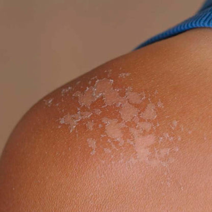Pack 10 Jabón Natural De Caléndula - Calma La Piel Seca, Con Dermatitis E Irritaciones - Cicatriza Y Alivia Quemaduras_3